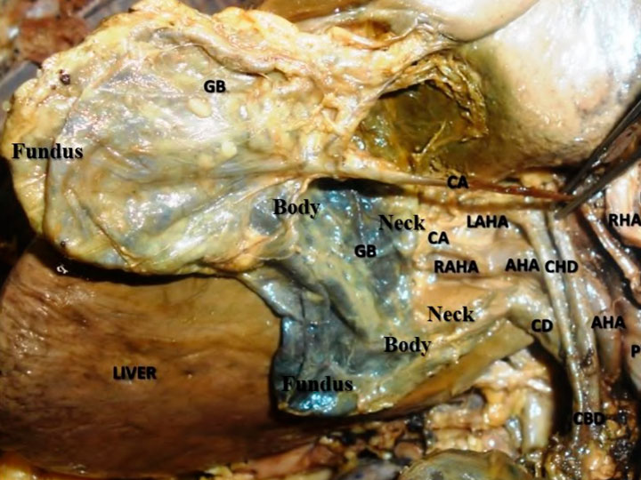 ‘Y’ shaped gallbladder associated with accessory cystic and hepatic arteries