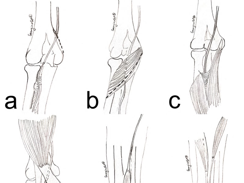 Median nerve entrapment by variant anatomical structures