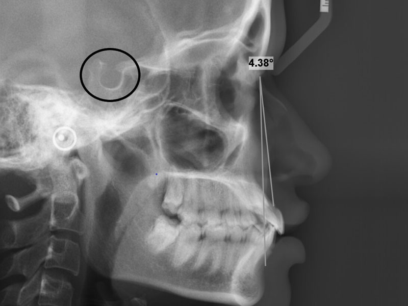Sella turcica anomalies and their association with malocclusion – a lateral cephalometric study