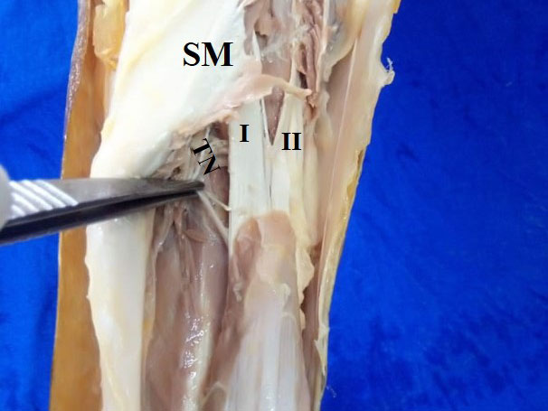 An unusual accessory soleus muscle with its clinical implications
