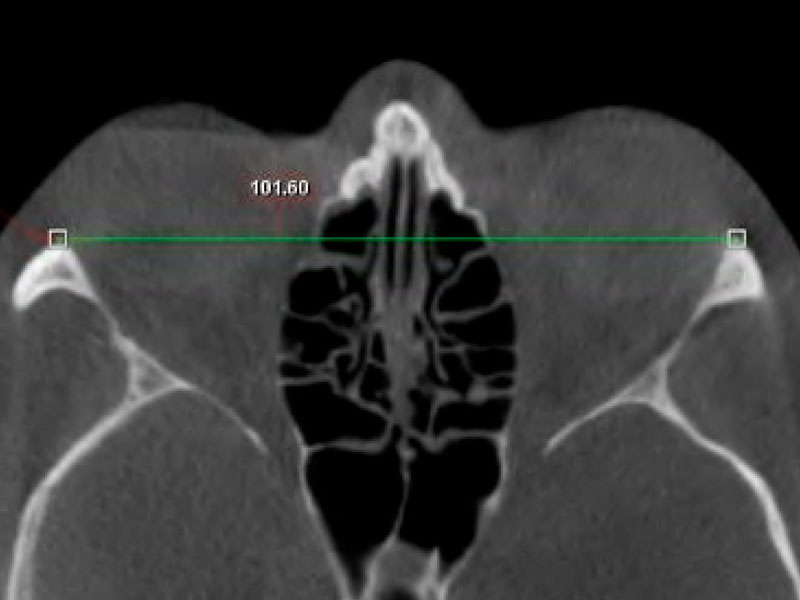 Bizygomatic distance as a predictor of age and sex determination: a morphometric analysis using cone beam computed tomography